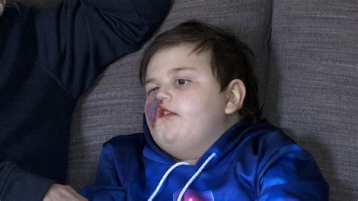 Jonah Burton Dies from Brain Cancer