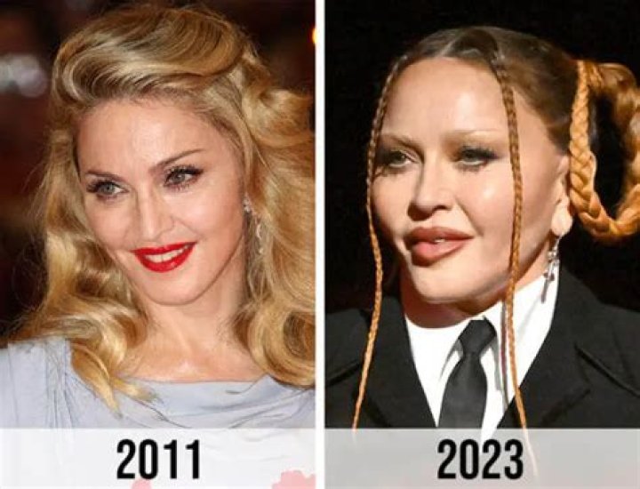 madonna plastic surgery